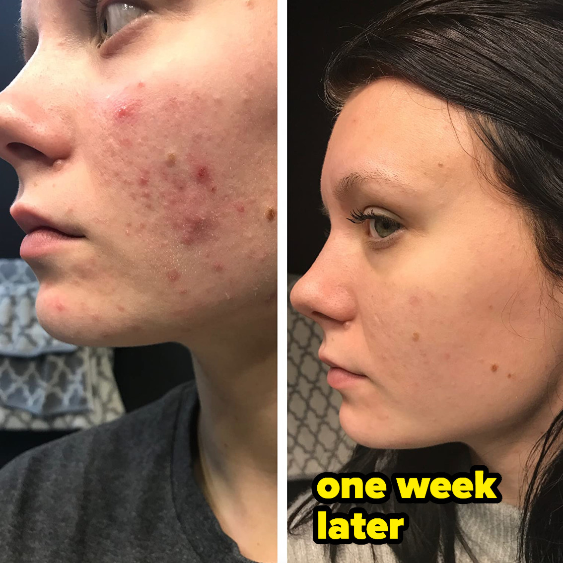 Before and after pic of reviewer with cystic acne 