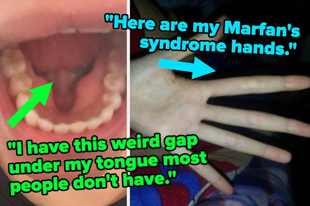 https://img.buzzfeed.com/buzzfeed-static/static/2022-07/19/18/campaign_images/9c62930e1740/marfans-syndrome-mandibular-tori-and-17-more-real-2-3299-1658254784-0_dblbig.jpg?resize=1200:*