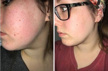 A reviewer's before and after photos after using Cerave cream - the left side has a lot of redness on the face, while the right side shows skin with very little redness and looks smoother