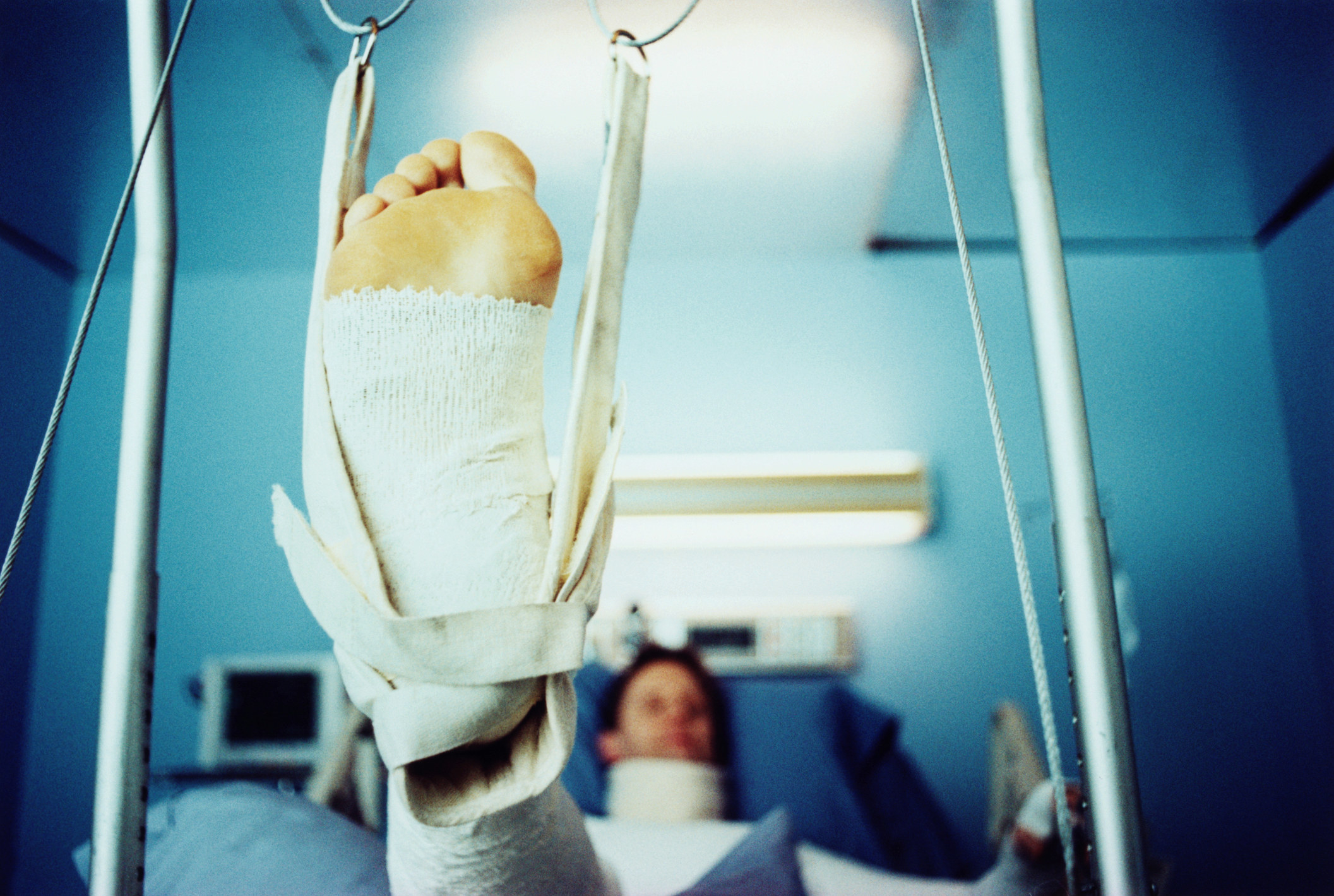 person in hospital bed with a broken leg