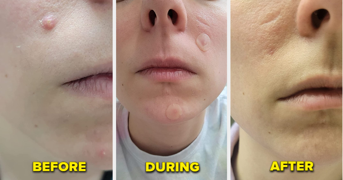 three photos of a reviewer&#x27;s progress before with acne, with the patches, and then after with clear skin