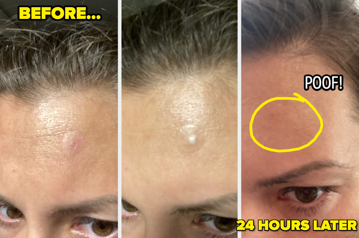 reviewer shows a pimple-free forehead after leaving the patch on for 24 horus