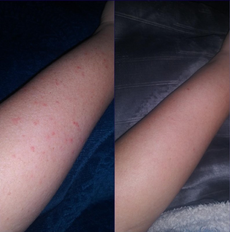 A reviewer&#x27;s before photo of their arm with red bumps and a reviewer&#x27;s after photo of their arm without bumps