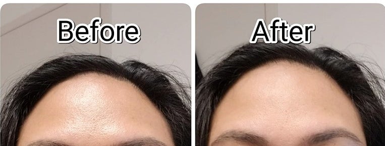 A reviewer&#x27;s photo of a oily forehead and a reviewer&#x27;s matte forehead after using the product