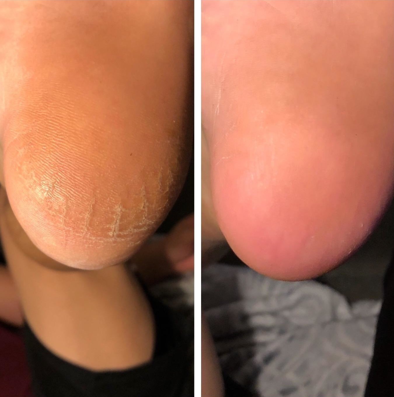 Review photo of before and after the callus remover