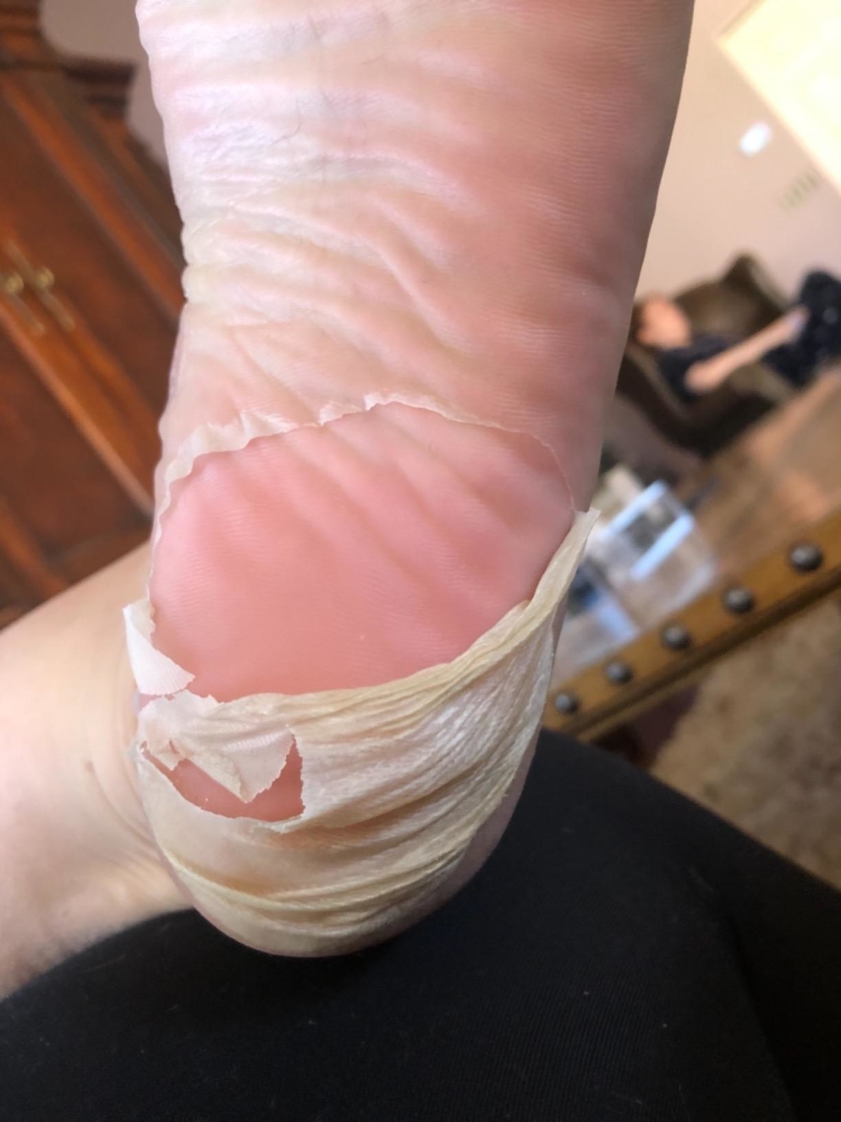 A reviewer&#x27;s photo of their dead skin coming off their feet