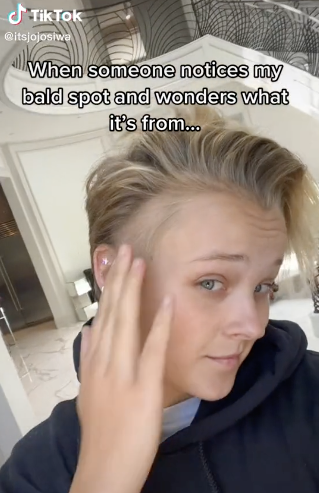 JoJo pulls her hair to one side, revealing a bald spot on the side of her head above her ear