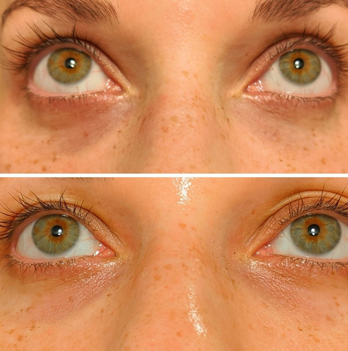 A reviewer showing their dark under eye circles before using this product and the reviewer&#x27;s after photo of a much brighter and lighter under eye