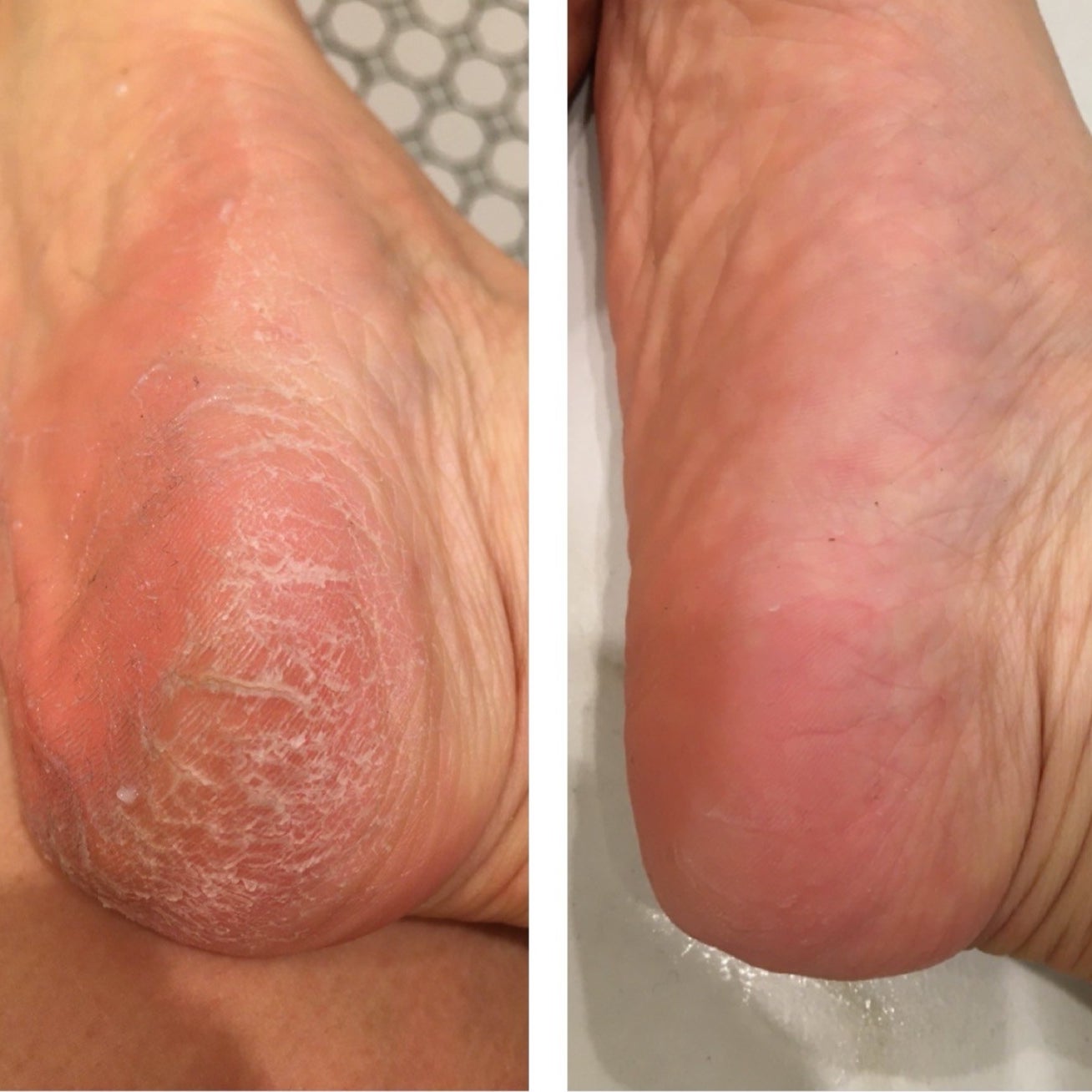 reviewer showing heel with dry cracked skin before using the remover and smooth heel after using the remover