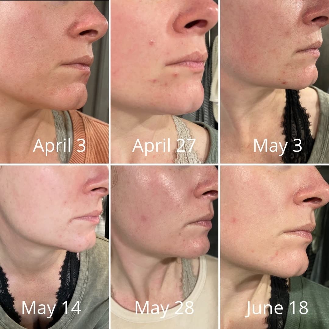 reviewer showing the effects of the exfoliator over two months