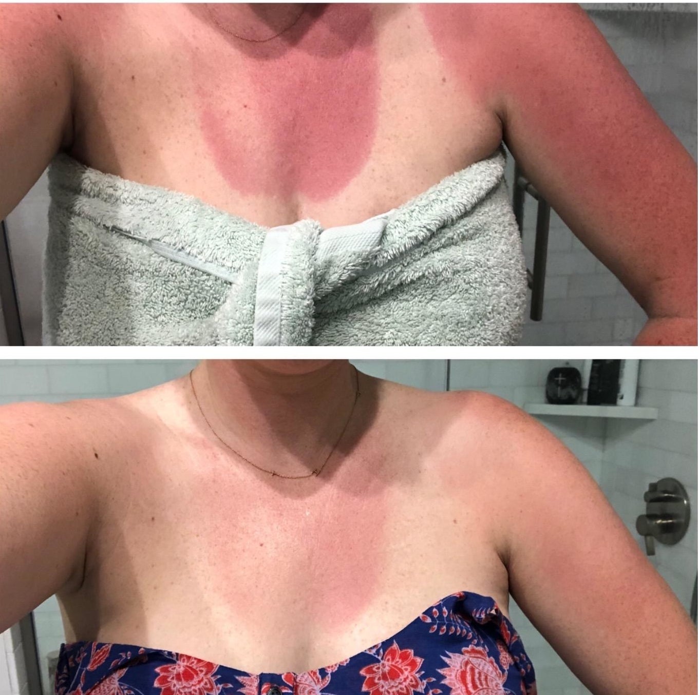 A reviewer with a giant sunburn oval on their chest prior to using product, the second photo is the same sunburnt oval but the color has faded a lot