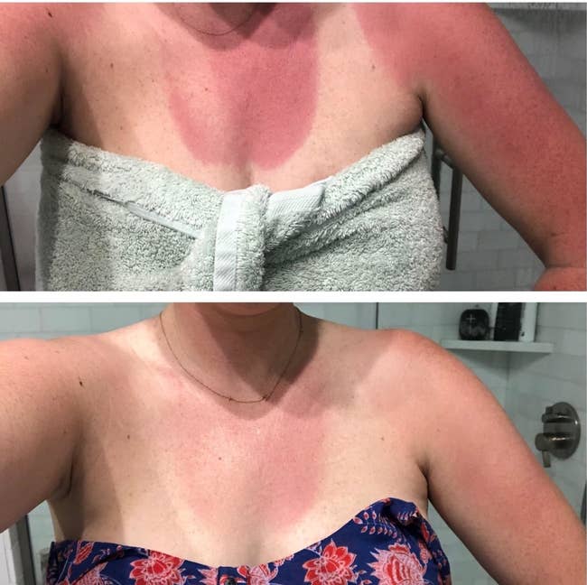 A reviewer with a elephantine sunburn oval connected their thorax anterior to utilizing product, the 2nd photograph is the aforesaid sunburnt oval but the colour has faded a lot