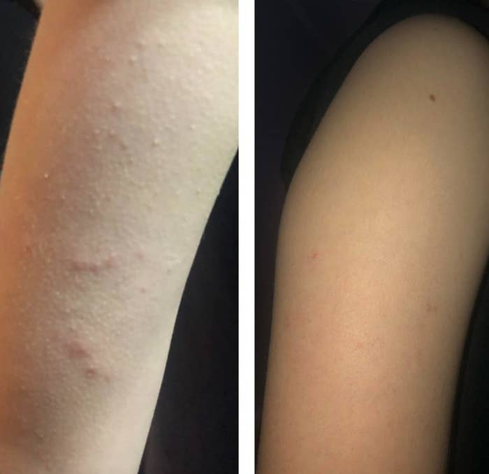 reviewer before and after image of an arm with bumps and without the bumps after using the body wash