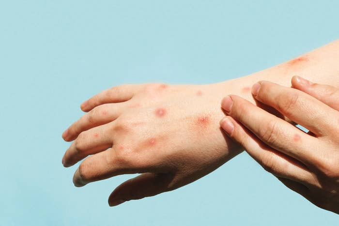 A person itches their hand with symptoms of what appears to be monkeypox