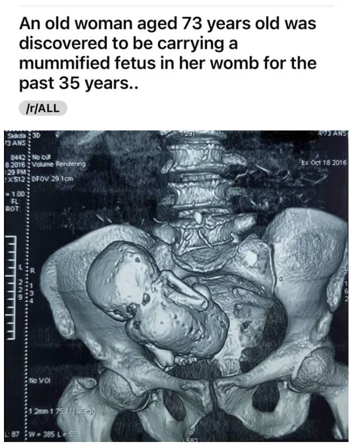 a fetus nestled in someone&#x27;s pelvic area