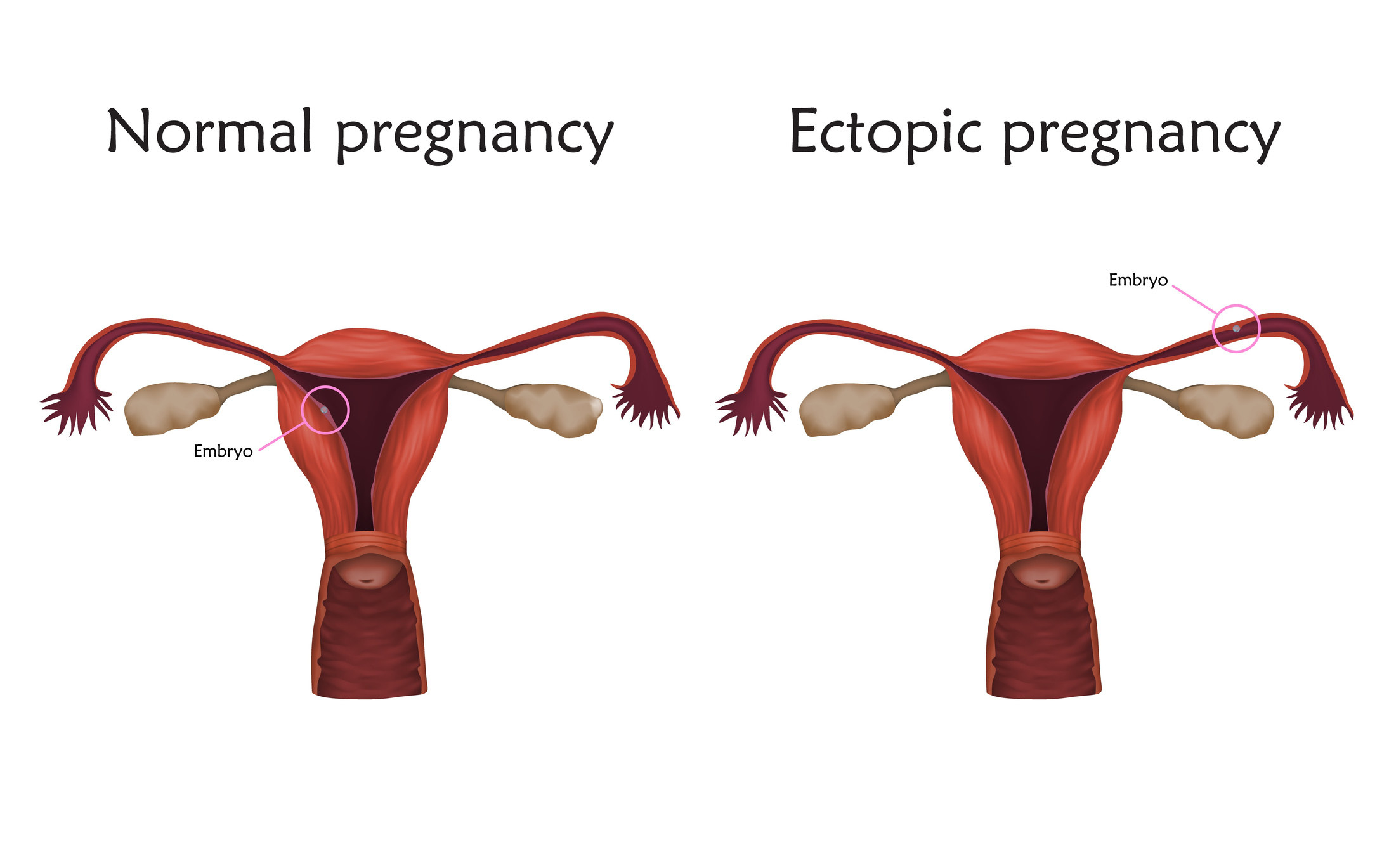 graph showing the difference of a normal pregnancy and an ectopic
