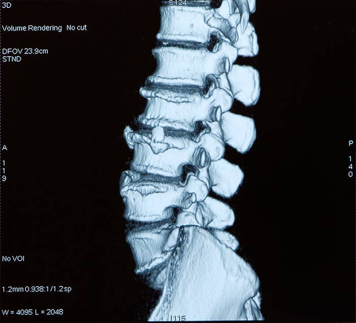 A spinal x-ray
