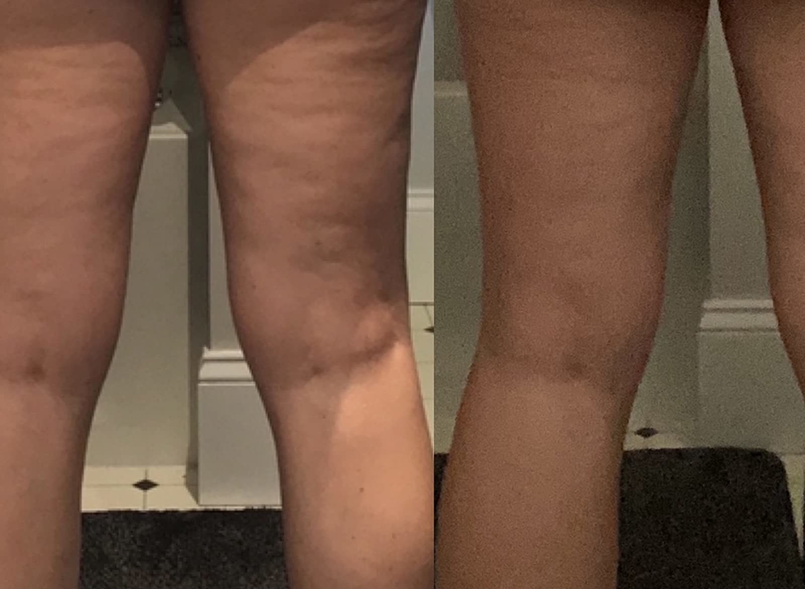 reviewer before and after photo of legs with loose skin before using the cream and legs with tight skin after using the cream