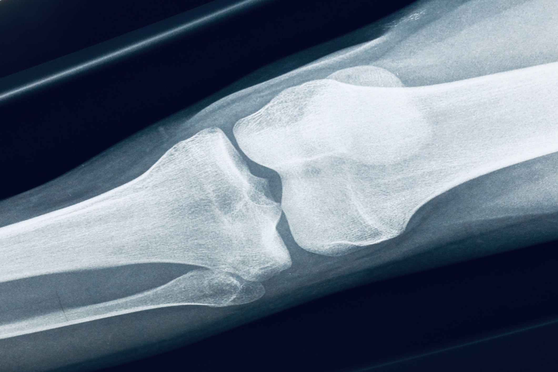 X-ray of a bone