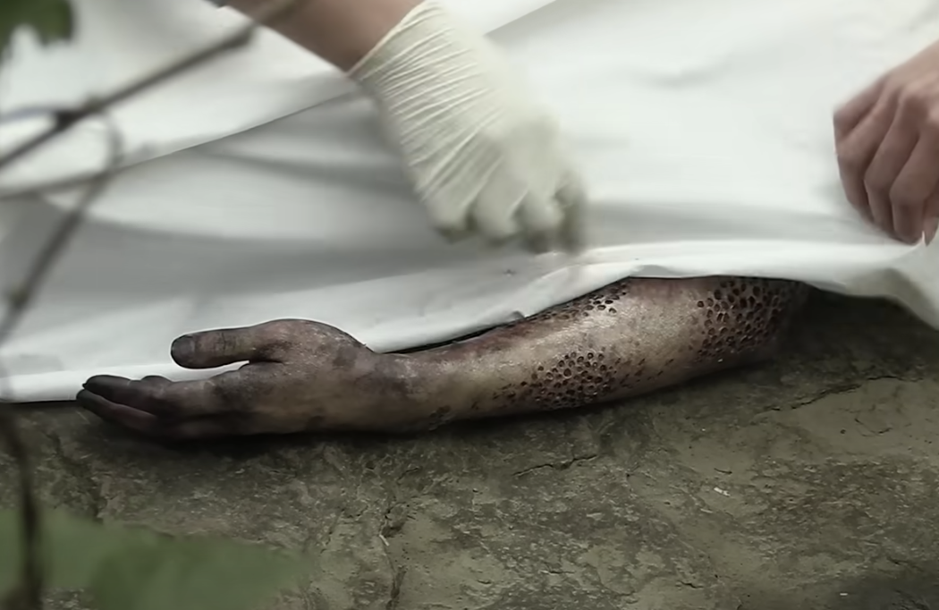 An arm of a corpse has many small holes in it
