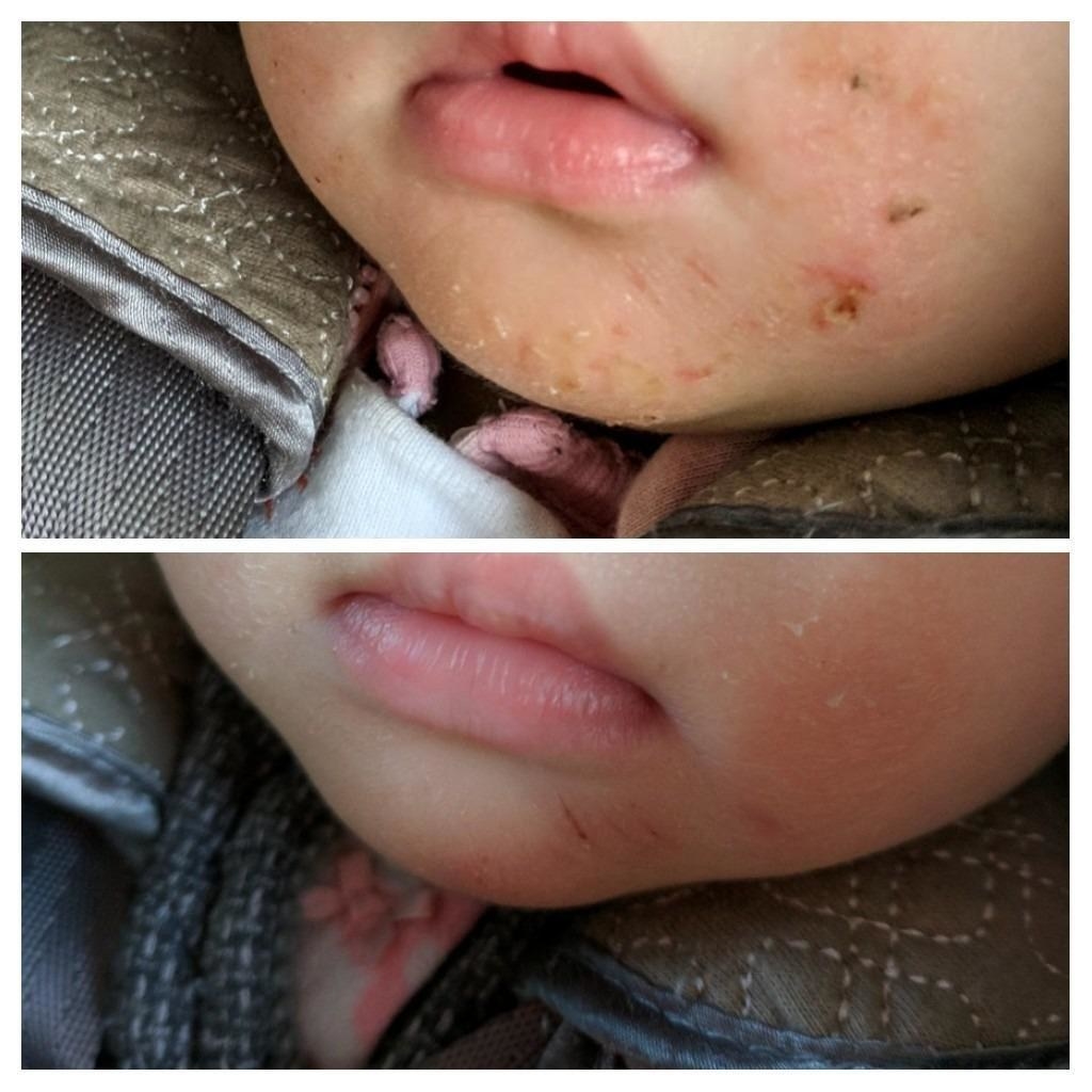 reviewer&#x27;s before photo showing their baby eczema and photo showing the eczema cleared up after using the cream