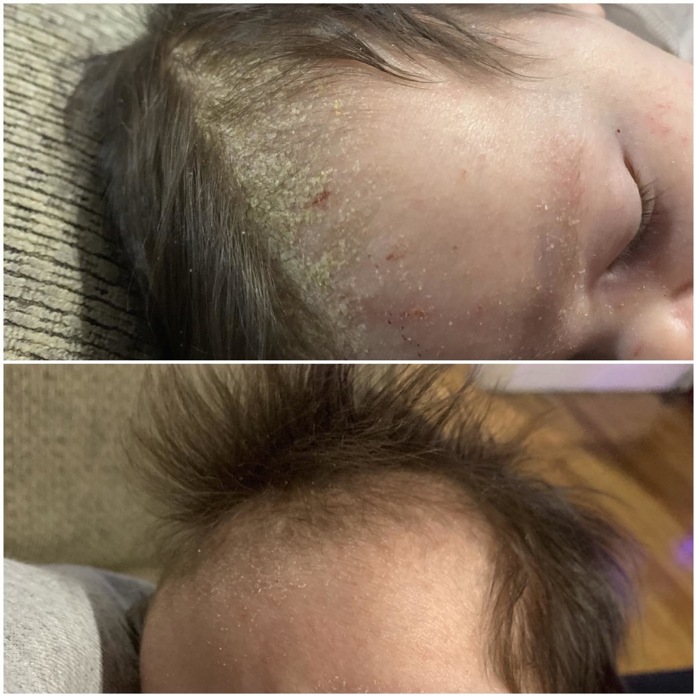 reviewer&#x27;s before and after cradle cap photos