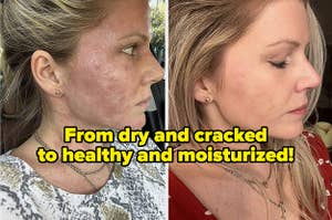before and after images of a reviewer with dry cracked skin that becomes healthy and moisturized