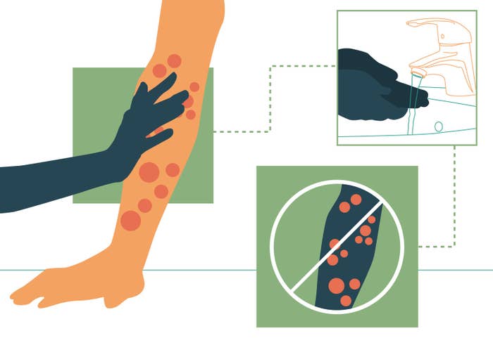 An infographic shows an arm with monkeypox touched by a hand, this image is connected to a box that shows the hand washing in a sink, this image connects to graphic that shows this person is not likely to catch Monkeypox