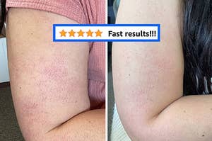 L: a reviewer's arm covered in red bumps, R: the same reviewer's arm with the look of redness and bumps reduced with a a snapshot of a five-star review titled "Fast results!!!"
