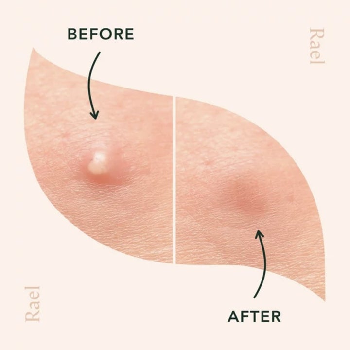 A before and after of acne patches
