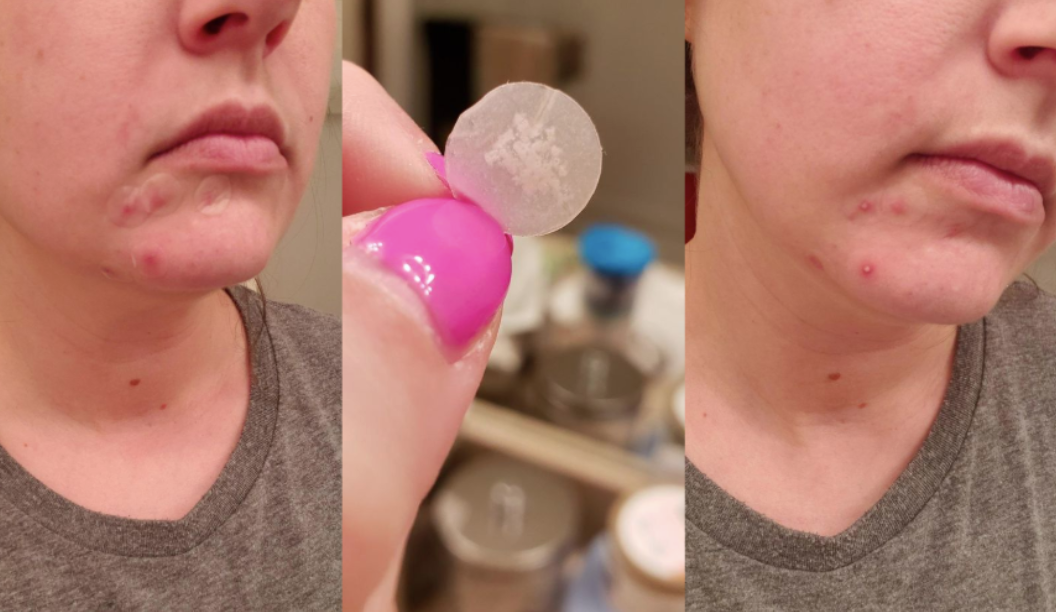 on left, reviewer wearing the acne patches on chin. in middle, reviewer holding a circular clear patch with puss drawn from acne. on right, puss coming out of acne covered by the patches