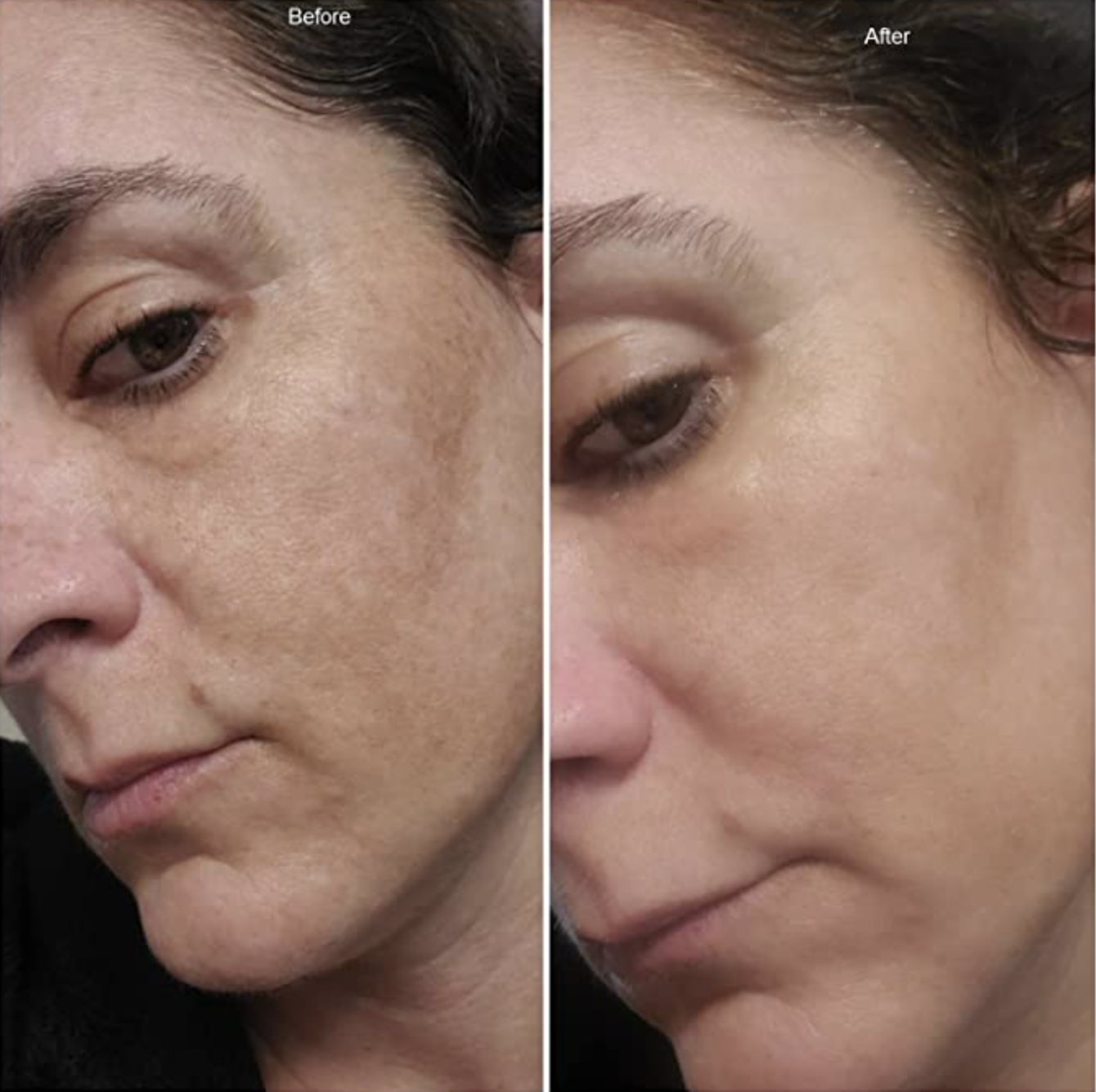 a model with dark spots on her face / the same model with clear skin after using the dark spot corrector