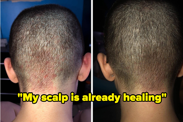 Reviewer's scalp before and after using shampoo brush