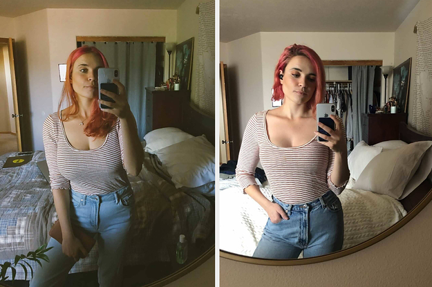 My body rejected my breast reduction leaving me with scars all over my  boobs, now I've learnt to embrace them