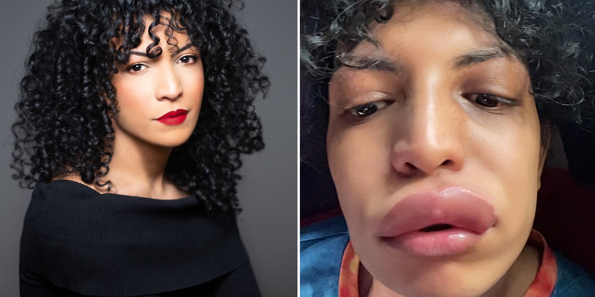 This Woman's Allergic Reaction Was Triggered By A Kiss - Vimarsana News