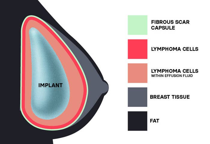 A diagram of a breast shows the layers of fibrous scar capsule, lymphoma cells, breast tissue, fat, and the implant itself