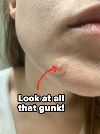 Same reviewer but now the pimple patch has a white circle in the middle