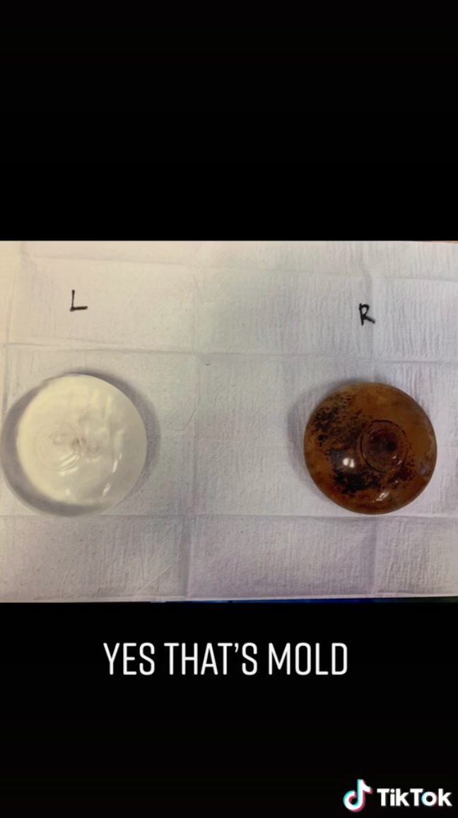 Melissa&#x27;s two breast implants side by side; one is clear, the other is very dark; the caption says that the dark one looks like that because it has mold