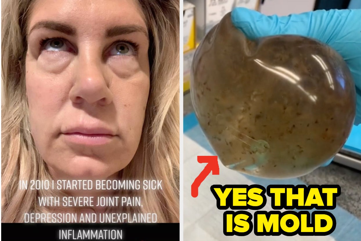 “Yes, That’s Mold” — For Years, This Woman Suffered Unimaginable Symptoms, Not Knowing Her Breast Implants Were The Cause. Here’s What You Need To Know About Breast Implant Illness.
