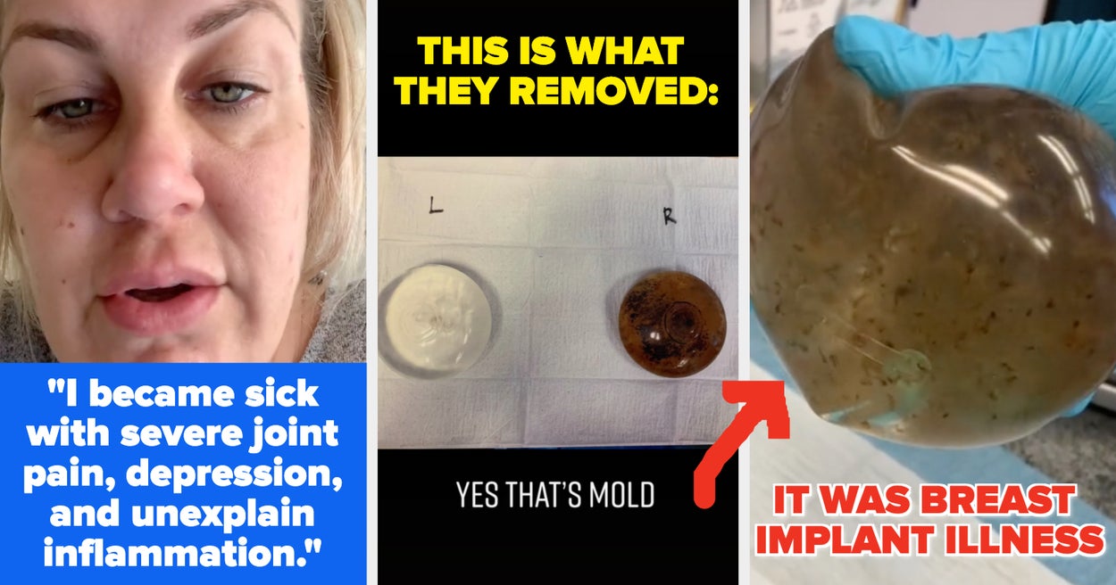 "Yes, That's Mold" — For Years, This Woman Suffered Unimaginable Symptoms, Not Knowing Her Breast Implants Were The Cause. Here's What You Need To Know About Breast Implant Illness.