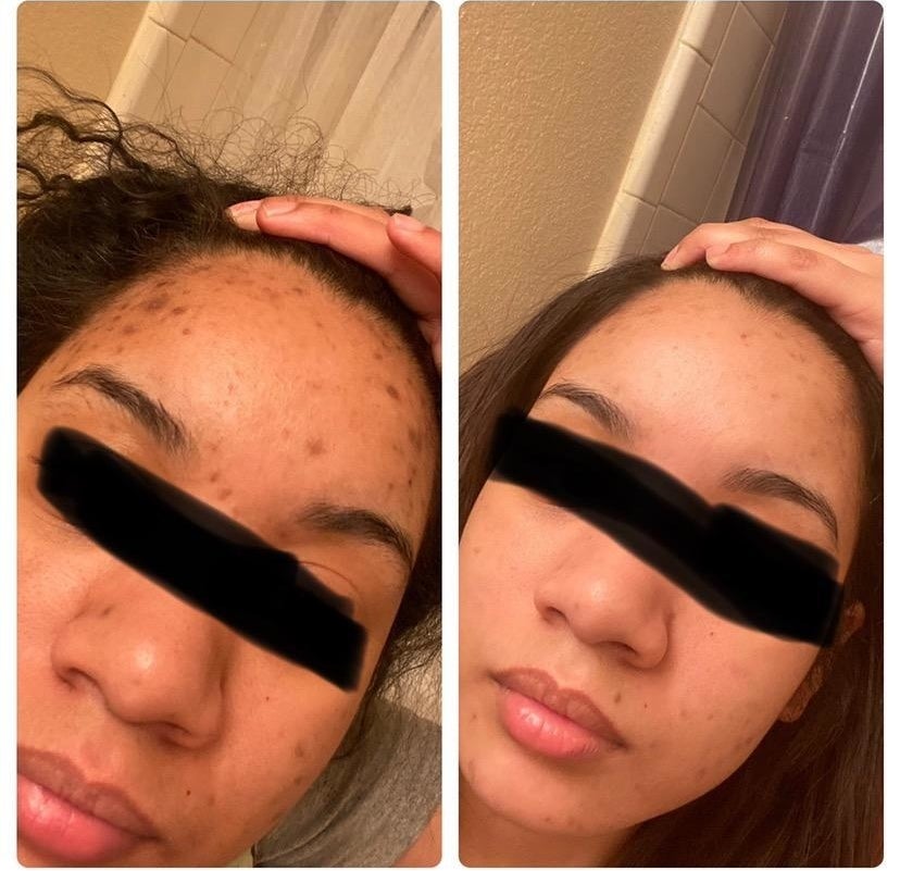 Reviewer with very dark scars and pigmentation on their forehead at the beginning of treatment and then with dramatically brighter skin after two weeks