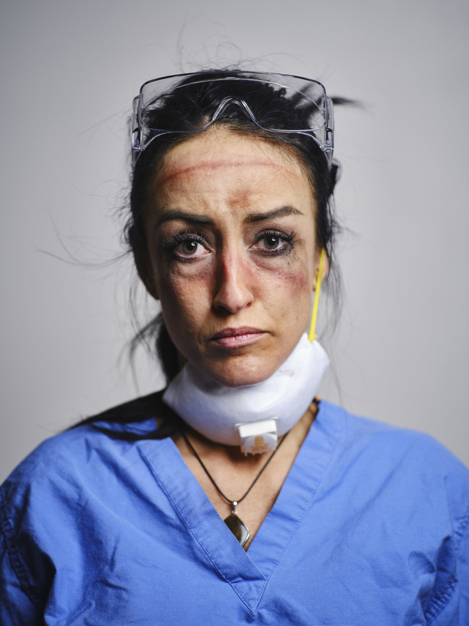 a medical worker with bruises on her face from her mask and glasses