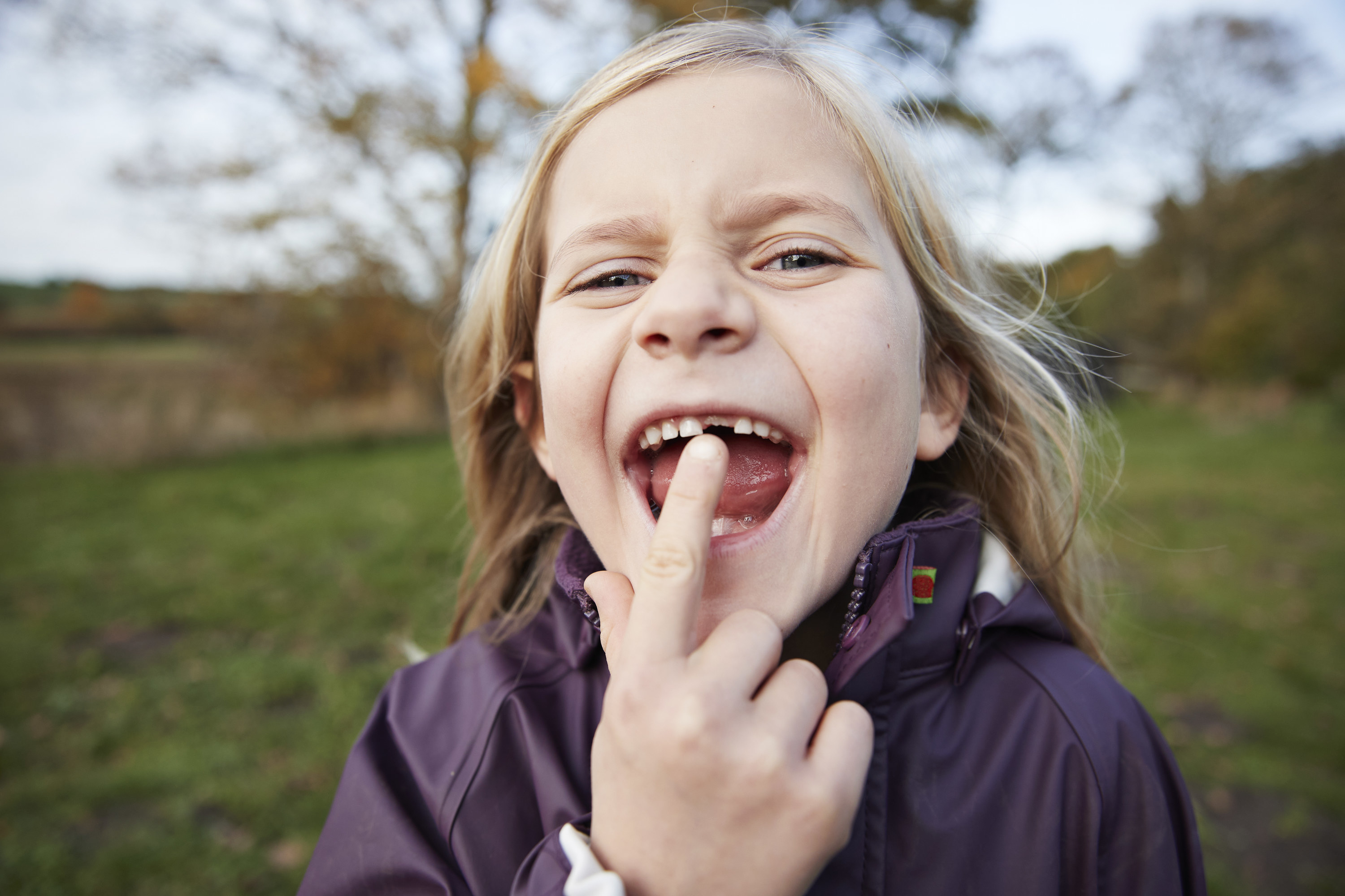 A kid showing their broken tooth