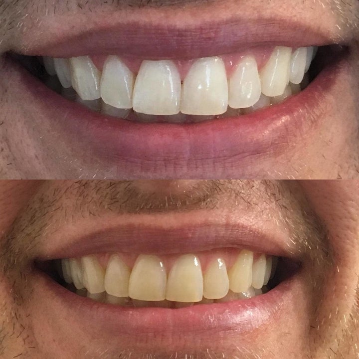 A reviewer's before after showing several shades of whitening