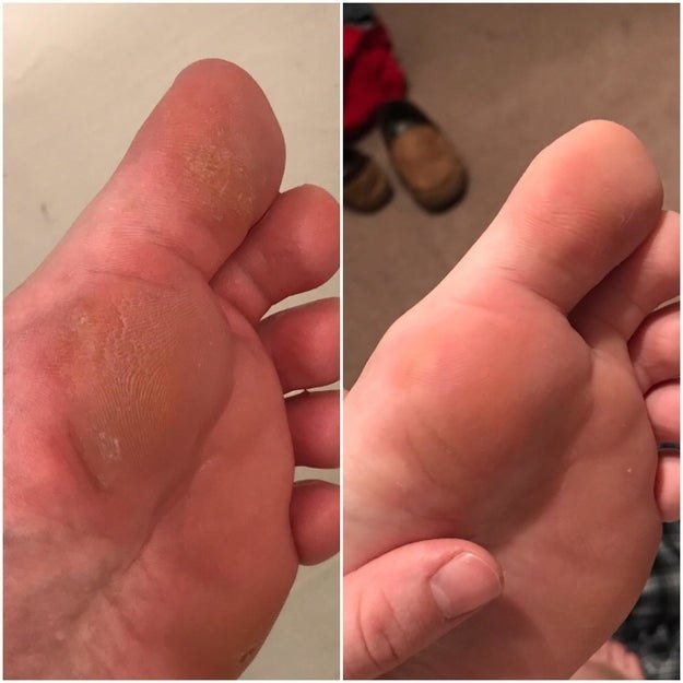 Reviewer&#x27;s foot before and after using callus gel