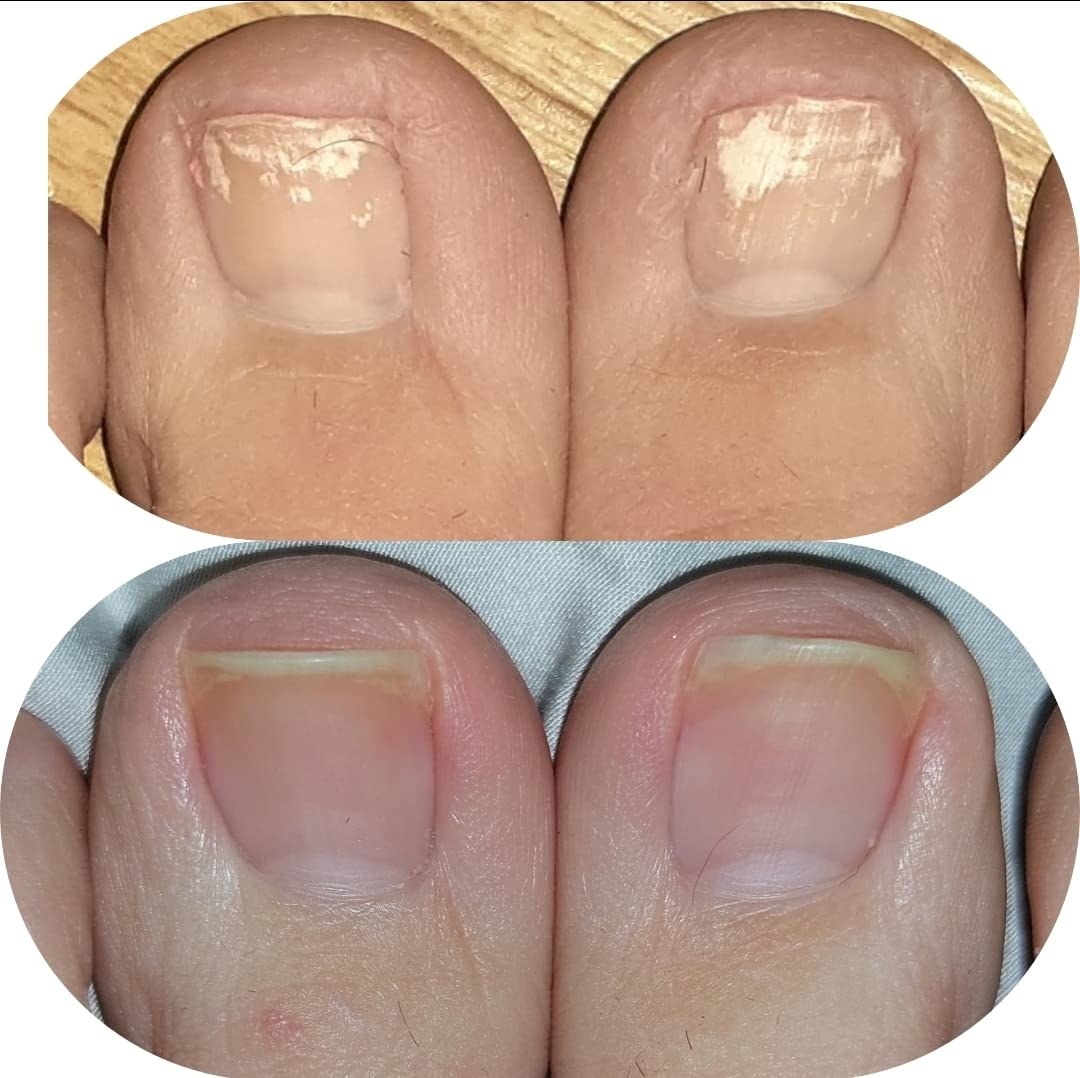 Before and after of reviewer&#x27;s toenail showing the pen got rid of their toenail fungus
