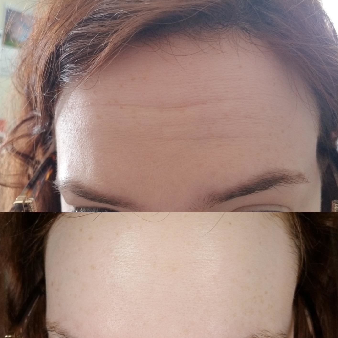 reviewer&#x27;s forehead before and after using the mask with a much more tightened look in the after