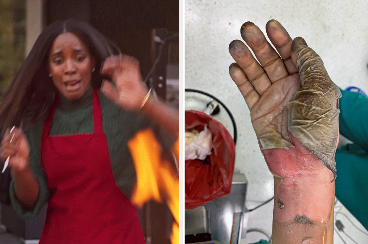 person scared in front of a flame and someone&#x27;s burned hand with the skin peeling off