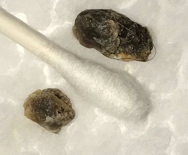 a reviewer photo of two balls of hard earwax next to a cotton swab for scale