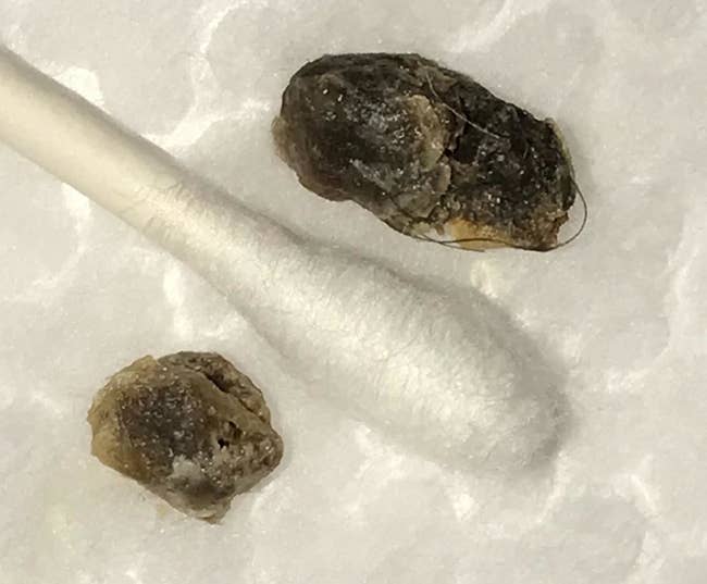 a reviewer's two balls of hard earwax next to a cotton swab for scale